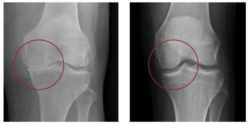 Illustration comparing healthy knee joint to one with osteoarthritis